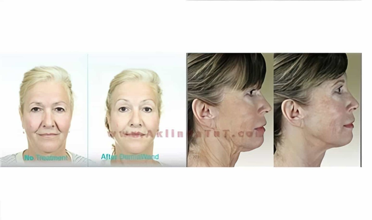 Derma Wand High Frekans Termal Enerji Cilt Bakım Cihazı Anti Aging - (yüz Ütüsü)