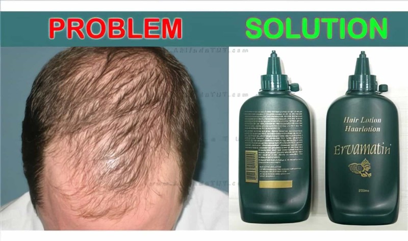 Ervamatin Saç Bakım Losyonu 2 Adet (orjinal) - Thumbnail