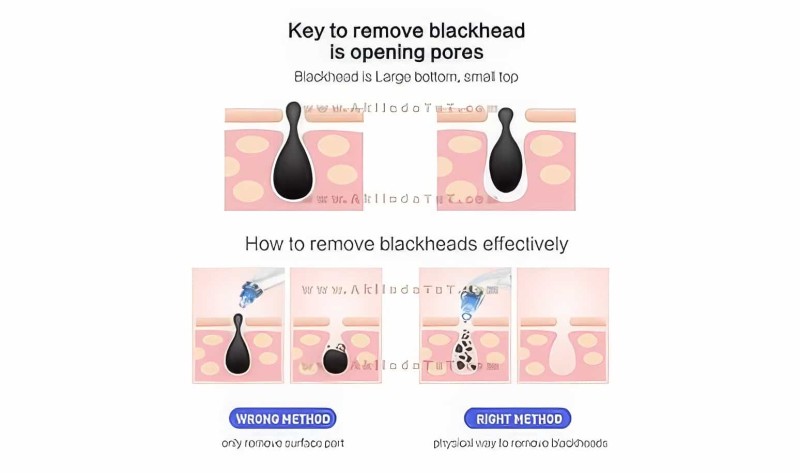 Vakumlu Siyah Nokta Gözenek Yağ Akne Temizleme Cilt Bakım Cihazı (şarjlı Profosyonel Model) - Thumbnail