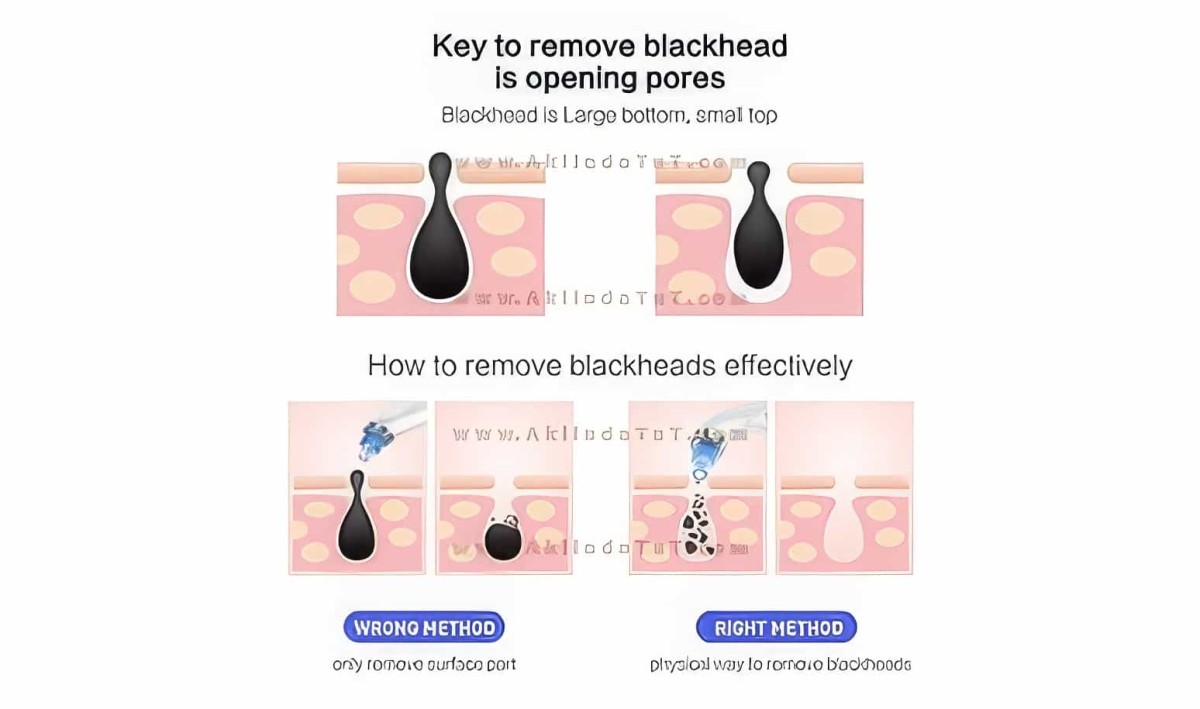 Vakumlu Siyah Nokta Gözenek Yağ Akne Temizleme Cilt Bakım Cihazı (şarjlı Profosyonel Model)